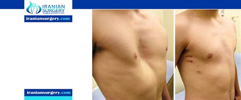 chest wall deformities types  chest wall deformities iranian surgery