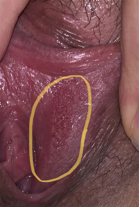 Is This Herpes Genital Herpes Simplex Forums Patient