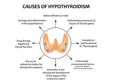 What Is Hypothyroidism And Is It Treatable Healthproadvice