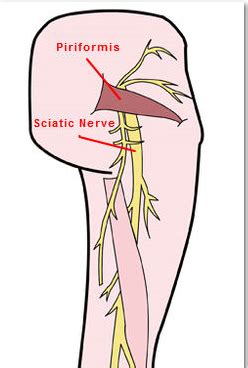 sciatic nerve pain relief begs  good posture