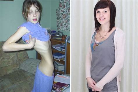 Anorexic Girl Saved By Mcdonalds Job Jo Thompson Beats Killer Disease