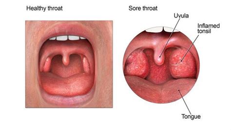 what causes strep throat entirely health