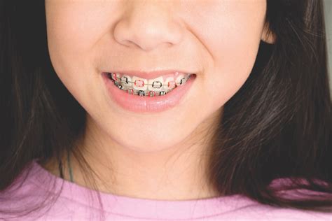 Orthodontist In Charleston Sc How To Personalize Braces