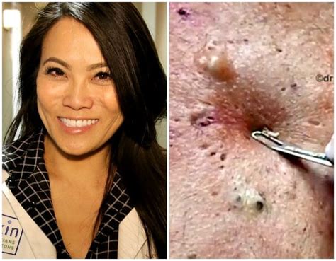 Dr Lee Pimple Popper On The Correct Diy Pimple Popping Technique