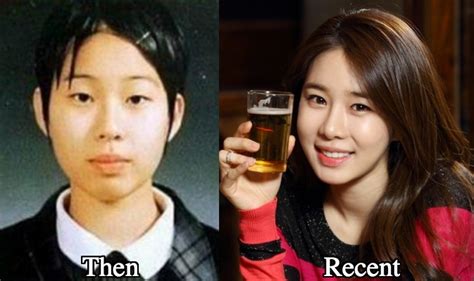 Yoo In Na Plastic Surgery Before And After Photos Latest