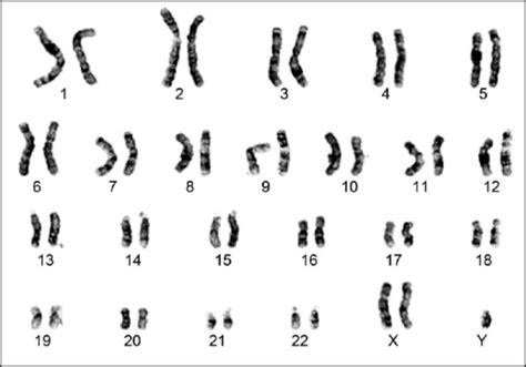 G Banded Karyotype Showing 47 Xxy Chromosomal Complemen Open I