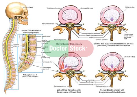 classic lumbar disc herniation  nerve root impingement doctor stock