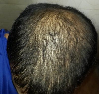 dead hair follicles regrow  prp hair loss treatment