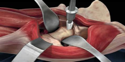 How Effective Is An Anterior Hip Replacement Aditi