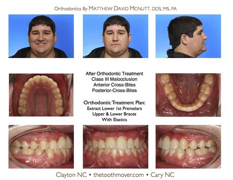 Class Iii Treatment Photos Orthodontics Cary Nc Clayton Nc