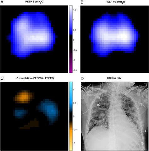 electrical impedance tomography measurement   covid  patient  scientific diagram