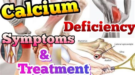 calcium deficiency symptoms  treatment youtube