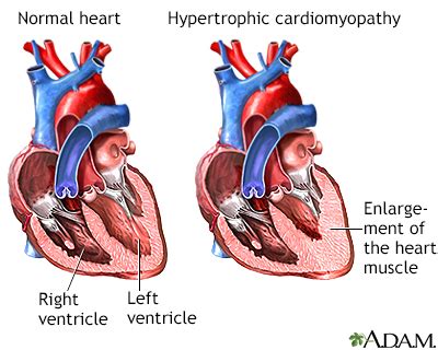 hie multimedia hypertrophic cardiomyopathy