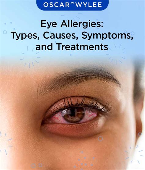 eye allergies types  symptoms  treatments