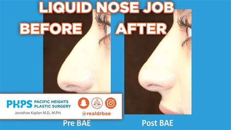 liquid nose job  radiesse pacific heights plastic surgery dr