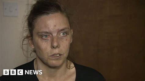 Carla Whitlock Acid Attack Victim Is Still Struggling Bbc News