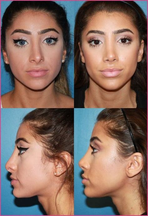 nose job rhinoplasty before and after plasticsurgery beforeandafter beforeafter