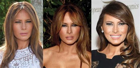 Melania Trump Plastic Surgery Before And After Pictures 2021