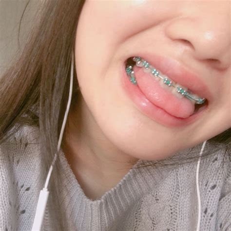 √ Cutest Braces Colors