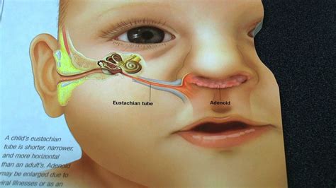 pediatric ear infections youtube