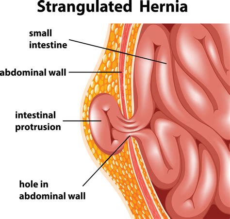 ventral hernia repair comprehensive hernia center brown surgical