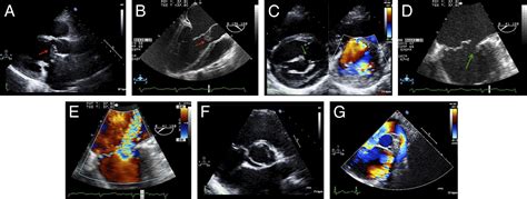 Accessory Mitral Valve Associated With Mitral Cleft Bicuspid Aortic