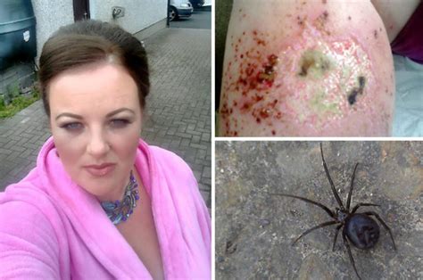 false widow spider bite nearly costs british mum her leg daily star