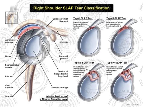slap tear classification