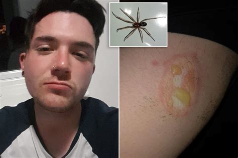 une araignée laisse l homme avec une blessure mangeuse de chair qui ne
