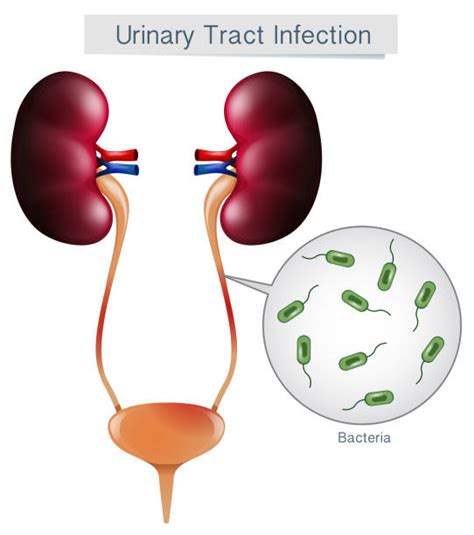 Best Urinary Tract Infection Illustrations Royalty Free