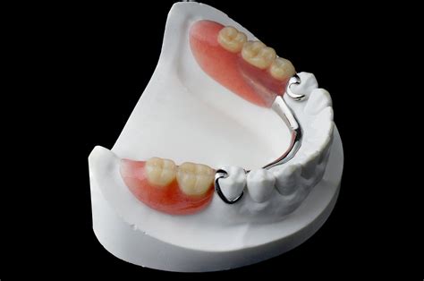 herausnehmbarer zahnersatz zahnarzt koeln maarweg