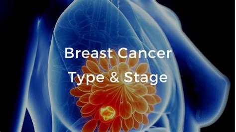 breast cancer basics video course breast cancer school for patients