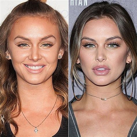 Celebrity Lip Injection Lip Injections Cheek Fillers Botox
