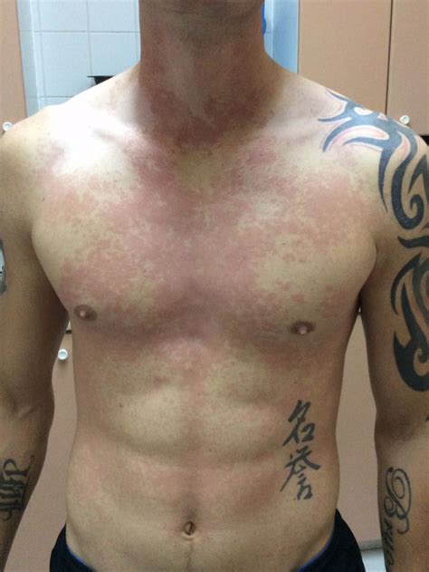 Unusual Case Of Suspected Recurrent Scarlet Fever In A Uk Serviceman
