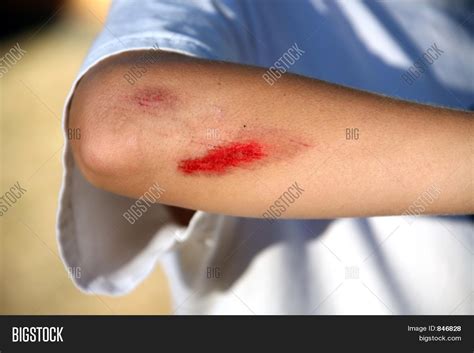 bleeding injured boy image photo  trial bigstock