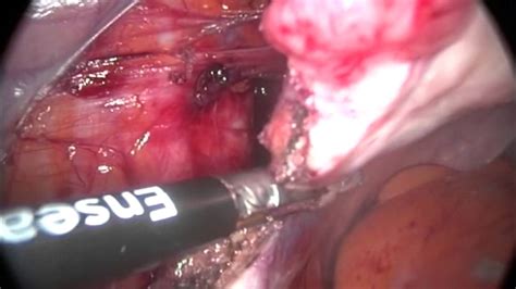 total laparoscopic hysterectomy bilateral salpingo