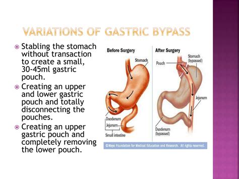 Ppt Gastric Bypass Surgery Powerpoint Presentation Free