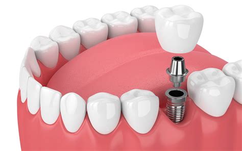 dental implants dental implant specialists beechview dental