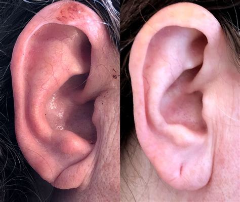 Before And After Photos Earlobe Repair 3 Nyc