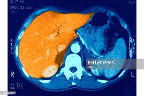 Ct Scan Liver Photos And Premium High Res Pictures Getty Images