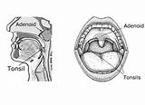Tonsil Anatomy Disease Adenoidectomy sketch template