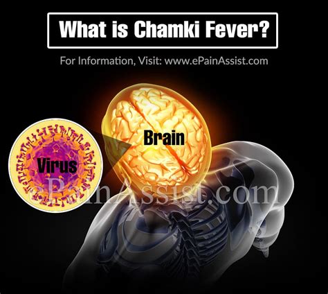 chamki fever    treatedcauses symptoms prevention  chamki fever
