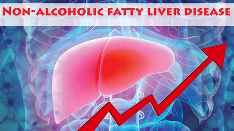 Non Alcoholic Fatty Liver Disease Is Often Caused By Obesity And