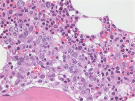 multiple myeloma bone marrow core