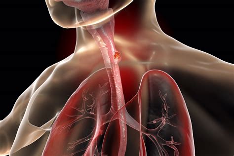 new immunotherapy based treatments for esophageal cancer show promise