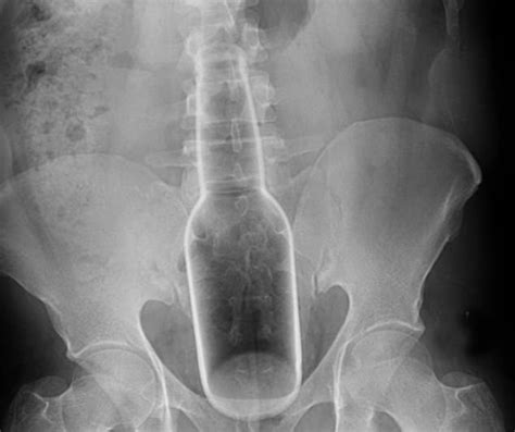 Bizarre Objects Stuck Inside Peoples Orifices That Required Emergency