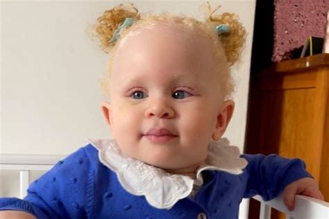 adorable baby born  albinism  suffers vile racial abuse