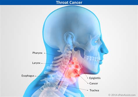Throat Cancer Types Causes Signs Symptoms Treatment