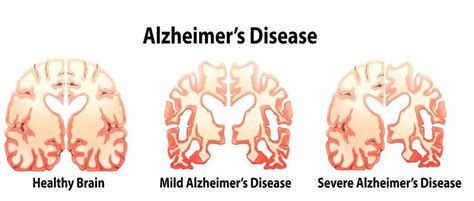 hersenscan brengt vroeg alzheimer aan het licht gezondheidbe