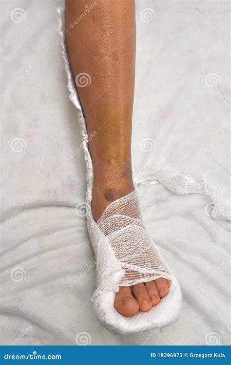 broken leg stock  image